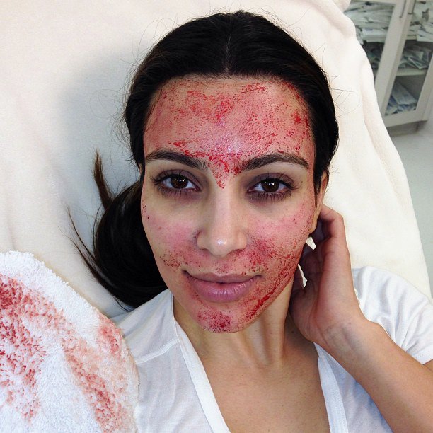 kim-kardashian-gets-painful-vampire-facial