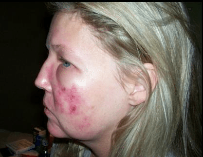 Woman Burned by Facial Warns of Spa Dangers