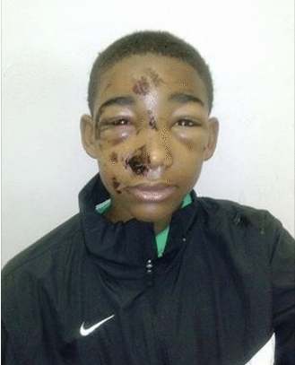 Was This 14-Year-Old Boy Brutally Tortured By Pennsylvania Police? (PHOTOS)