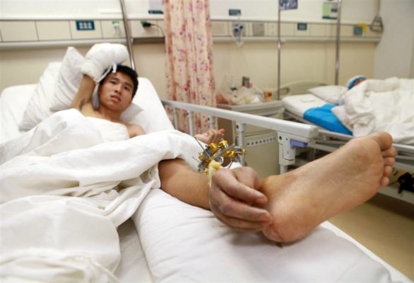 Severed hand attached to man’s ankle to keep it alive