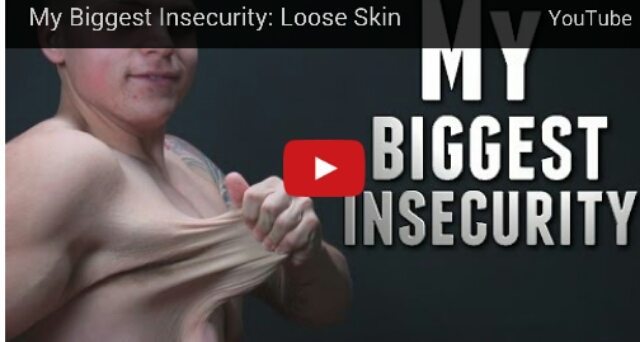 Watch – The Excess Skin You Carry After Losing 160 Pounds – Video